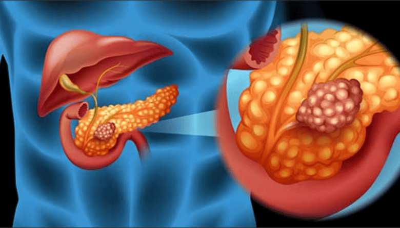Un avance que ilusiona: científicos lograron eliminar cáncer de páncreas en ratones