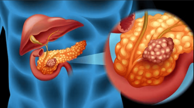 Un avance que ilusiona: científicos lograron eliminar cáncer de páncreas en ratones